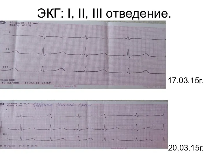 ЭКГ: I, II, III отведение. 17.03.15г. 20.03.15г.