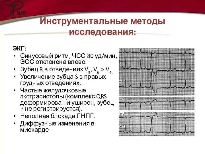 Инструментальные методы исследования: ЭКГ: Синусовый ритм, ЧСС 80 уд/мин, ЭОС отклонена