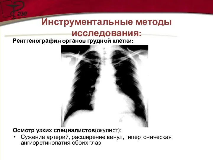 Рентгенография органов грудной клетки: Осмотр узких специалистов(окулист): Сужение артерий, расширение венул,