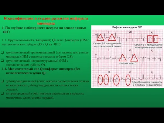 Классификация и стадии развития инфаркта миокарда 1. По глубине и обширности