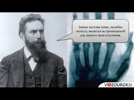 Значит костная ткань, подобно металлу, является не проницаемой для данного вида излучения.