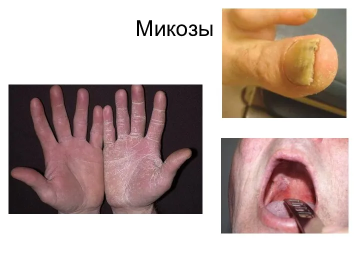 Микозы