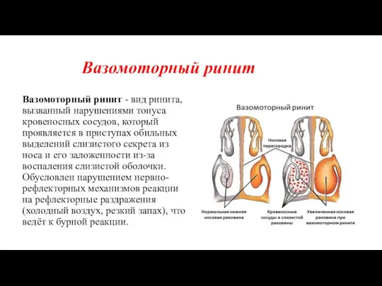 Вазомоторный ринит Вазомоторный ринит - вид ринита, вызванный нарушениями тонуса кровеносных