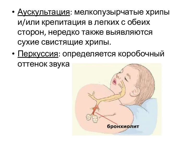 Аускультация: мелкопузырчатые хрипы и/или крепитация в легких с обеих сторон, нередко