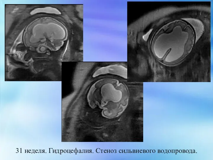 31 неделя. Гидроцефалия. Стеноз сильвиевого водопровода.