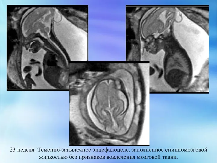 23 неделя. Теменно-затылочное энцефалоцеле, заполненное спинномозговой жидкостью без признаков вовлечения мозговой ткани.