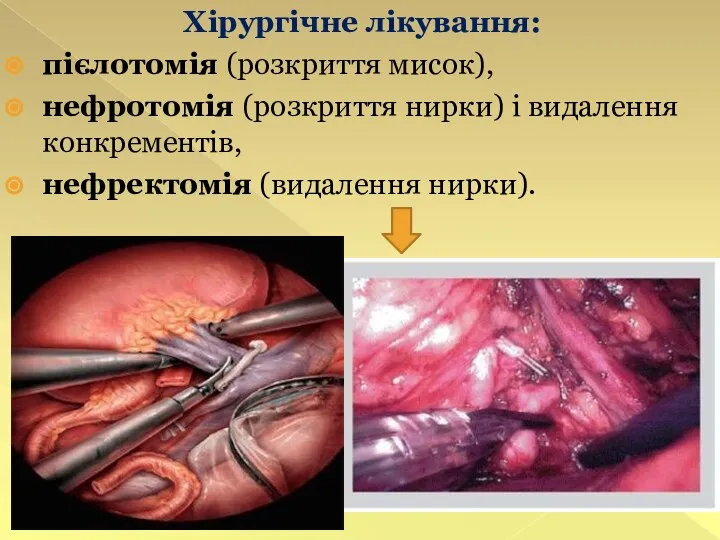 Хірургічне лікування: пієлотомія (розкриття мисок), нефротомія (розкриття нирки) і видалення конкрементів, нефректомія (видалення нирки).