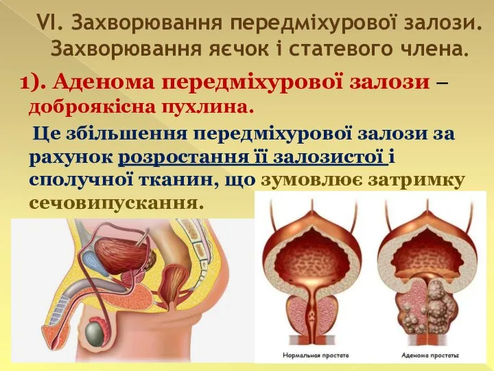VI. Захворювання передміхурової залози. Захворювання яєчок і статевого члена. 1). Аденома