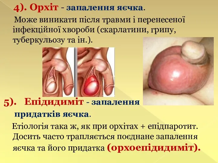4). Орхіт - запалення яєчка. Може виникати після травми і перенесеної
