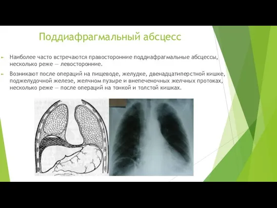 Поддиафрагмальный абсцесс Наиболее часто встречаются правосторонние поддиафрагмальные абсцессы, несколько реже —