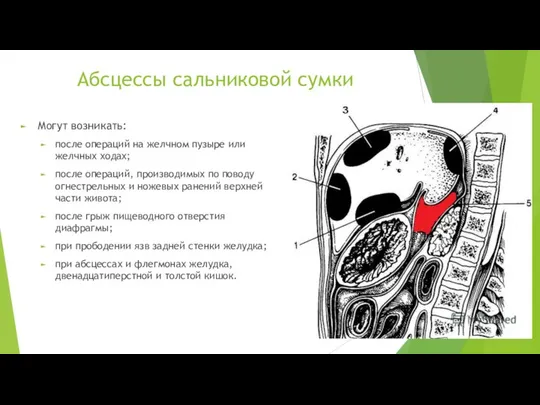 Абсцессы сальниковой сумки Могут возникать: после операций на желчном пузыре или