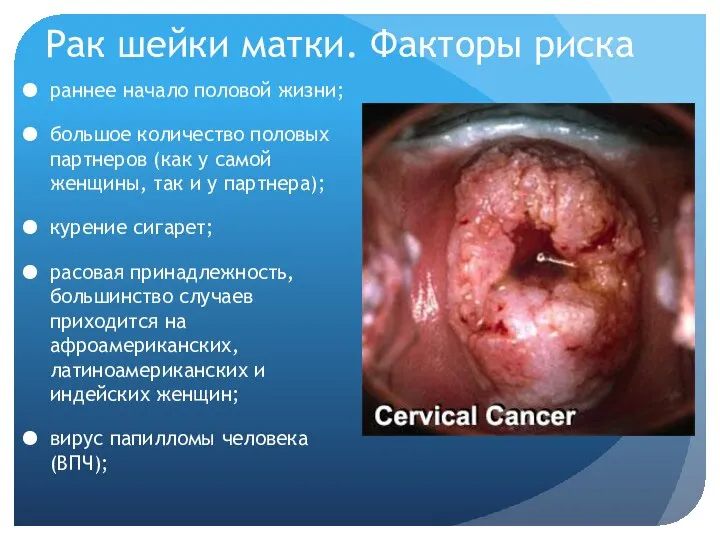 Рак шейки матки. Факторы риска раннее начало половой жизни; большое количество