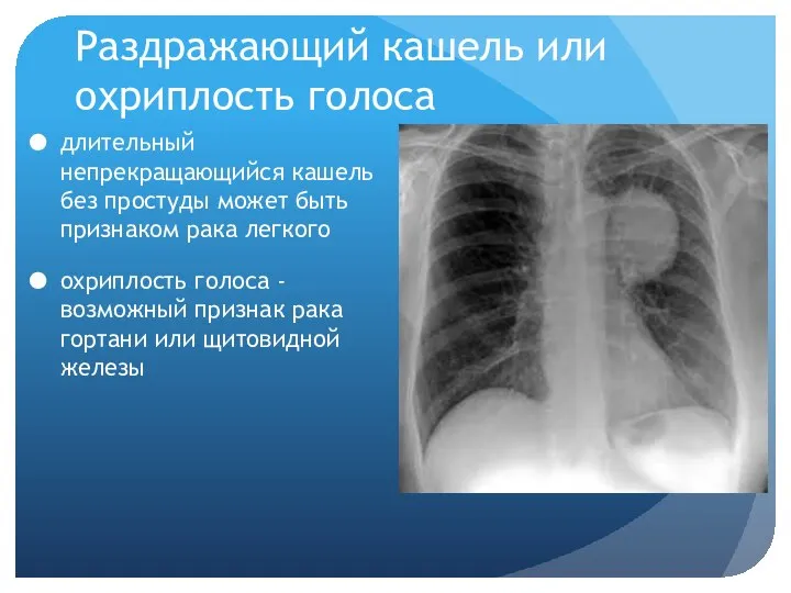 Раздражающий кашель или охриплость голоса длительный непрекращающийся кашель без простуды может