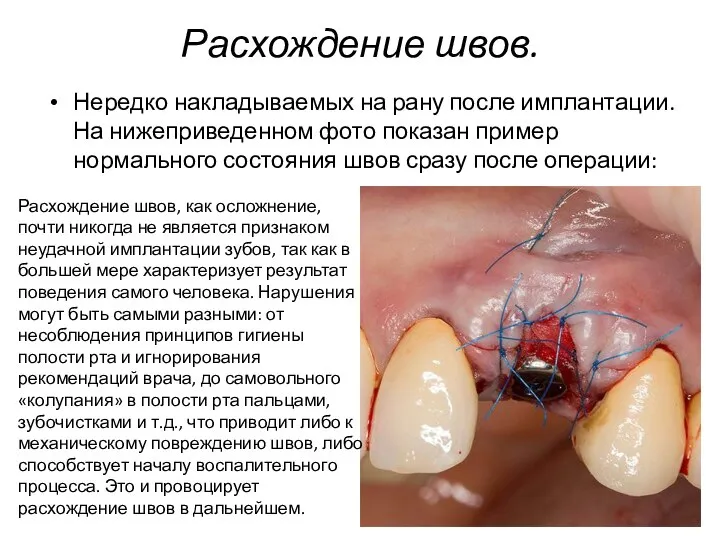 Расхождение швов. Нередко накладываемых на рану после имплантации. На нижеприведенном фото