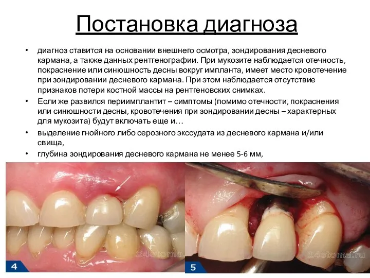 Постановка диагноза диагноз ставится на основании внешнего осмотра, зондирования десневого кармана,