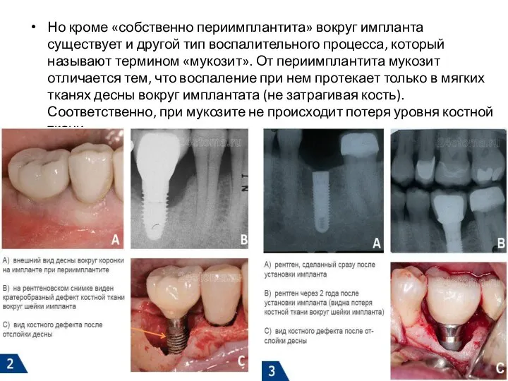 Но кроме «собственно периимплантита» вокруг импланта существует и другой тип воспалительного