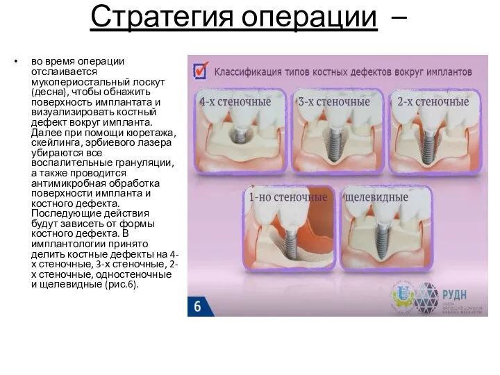 Стратегия операции – во время операции отслаивается мукопериостальный лоскут (десна), чтобы