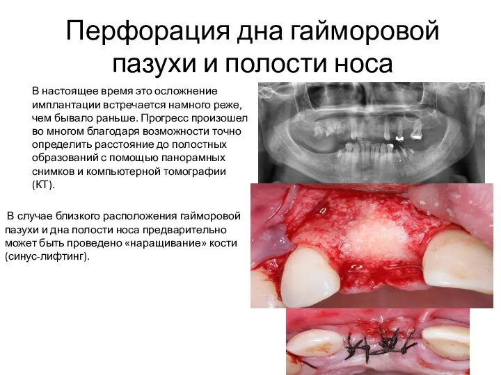 Перфорация дна гайморовой пазухи и полости носа В настоящее время это