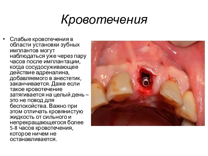 Кровотечения Слабые кровотечения в области установки зубных имплантов могут наблюдаться уже