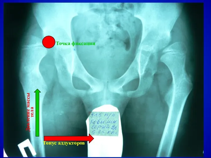 Тонус аддукторов Давление массы тела Точка фиксации