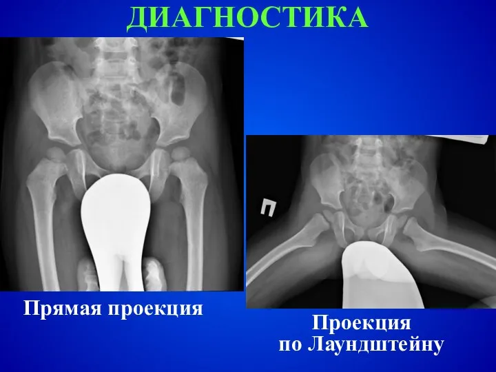 ДИАГНОСТИКА Прямая проекция Проекция по Лаундштейну