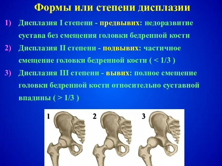 Дисплазия I степени - предвывих: недоразвитие сустава без смещения головки бедренной