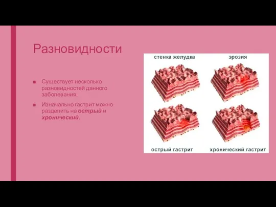 Разновидности Существует несколько разновидностей данного заболевания. Изначально гастрит можно разделить на острый и хронический.