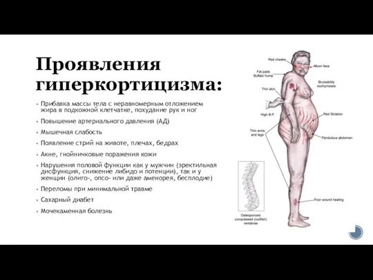 Проявления гиперкортицизма: Прибавка массы тела с неравномерным отложением жира в подкожной