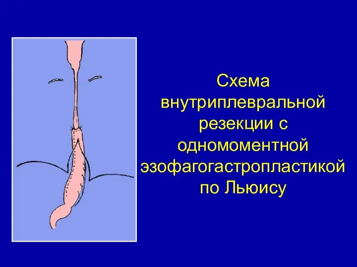 Схема внутриплевральной резекции с одномоментной эзофагогастропластикой по Льюису