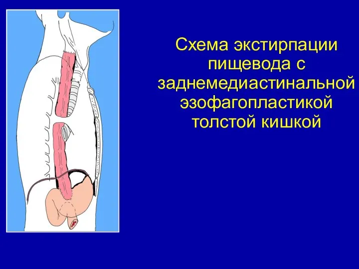 Схема экстирпации пищевода с заднемедиастинальной эзофагопластикой толстой кишкой