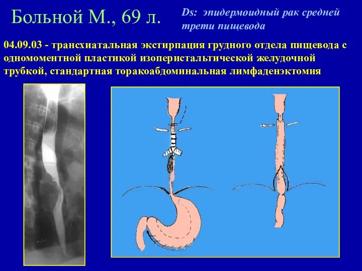 Больной М., 69 л. Ds: эпидермоидный рак средней трети пищевода 04.09.03