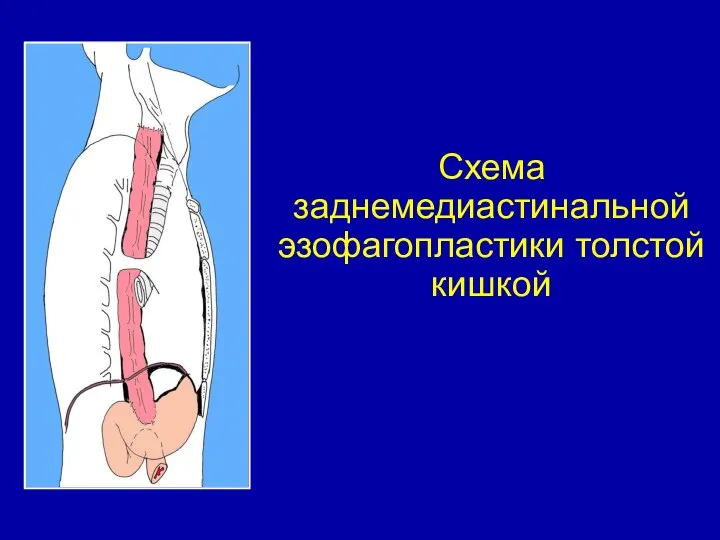 Схема заднемедиастинальной эзофагопластики толстой кишкой