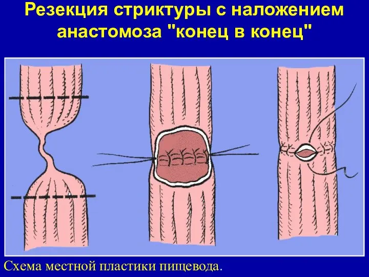 Резекция стриктуры с наложением анастомоза "конец в конец" Схема местной пластики пищевода.