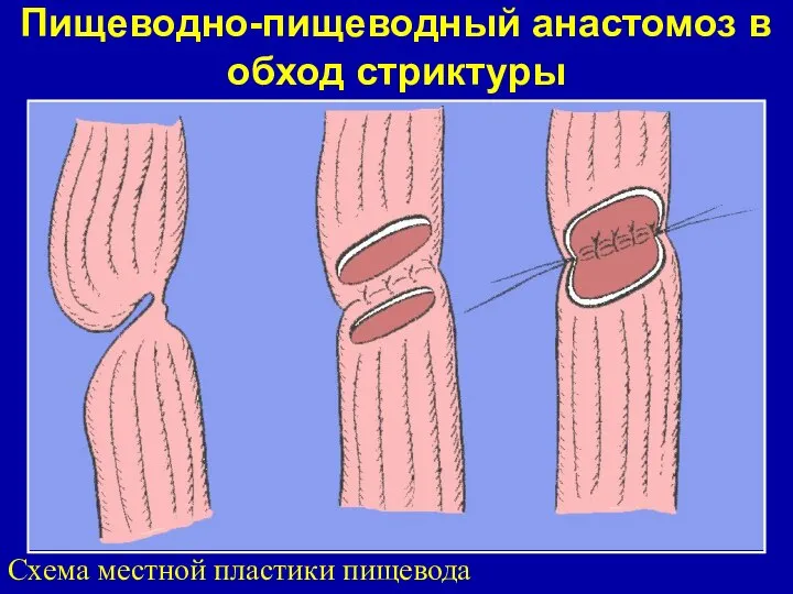 Пищеводно-пищеводный анастомоз в обход стриктуры Схема местной пластики пищевода