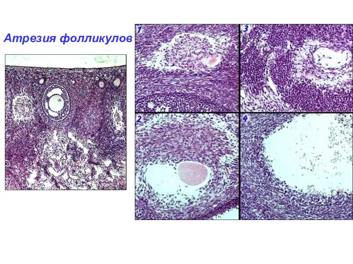 Атрезия фолликулов