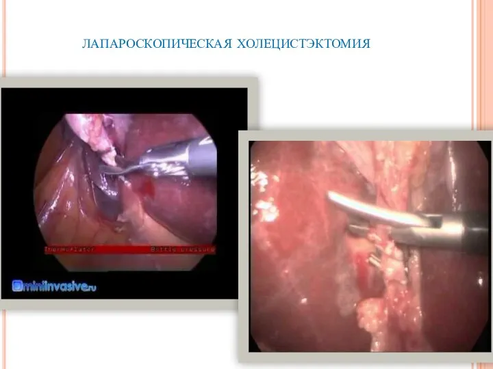лапароскопическая холецистэктомия
