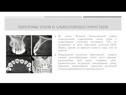 ПЕРЕЛОМЫ ЗУБОВ И АЛЬВЕОЛЯРНЫХ ОТРОСТКОВ По опыту Великой Отечественной войны огнестрельные