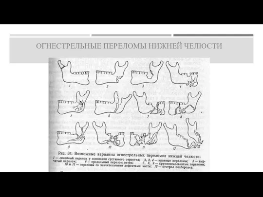 ОГНЕСТРЕЛЬНЫЕ ПЕРЕЛОМЫ НИЖНЕЙ ЧЕЛЮСТИ