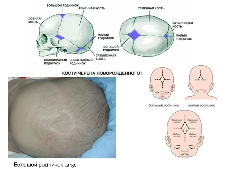 Большой родничок Large fontanelle