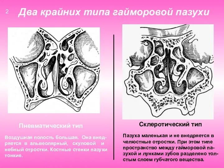 Два крайних типа гайморовой пазухи Пневматический тип Склеротический тип Воздушная полость