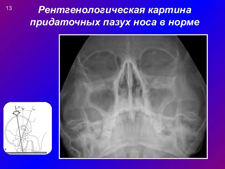 Рентгенологическая картина придаточных пазух носа в норме 13