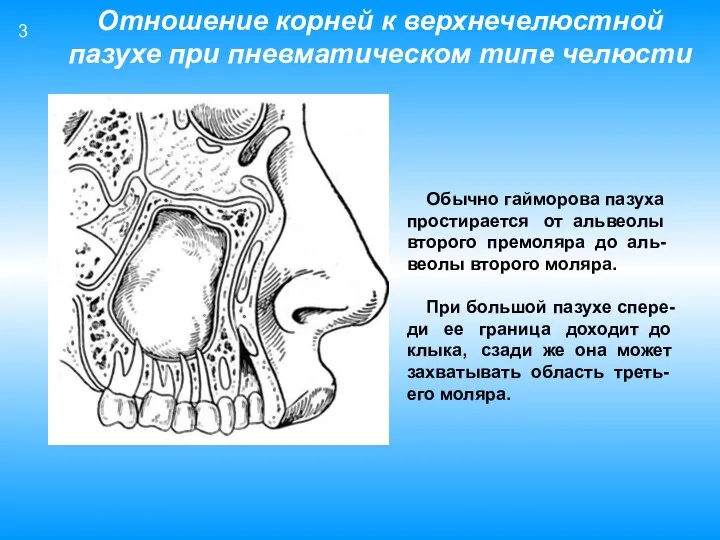 Обычно гайморова пазуха простирается от альвеолы второго премоляра до аль- веолы