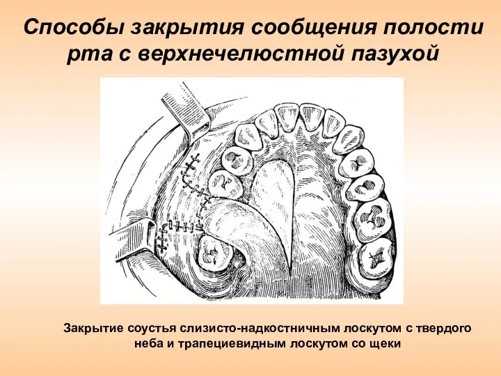 Способы закрытия сообщения полости рта с верхнечелюстной пазухой Закрытие соустья слизисто-надкостничным