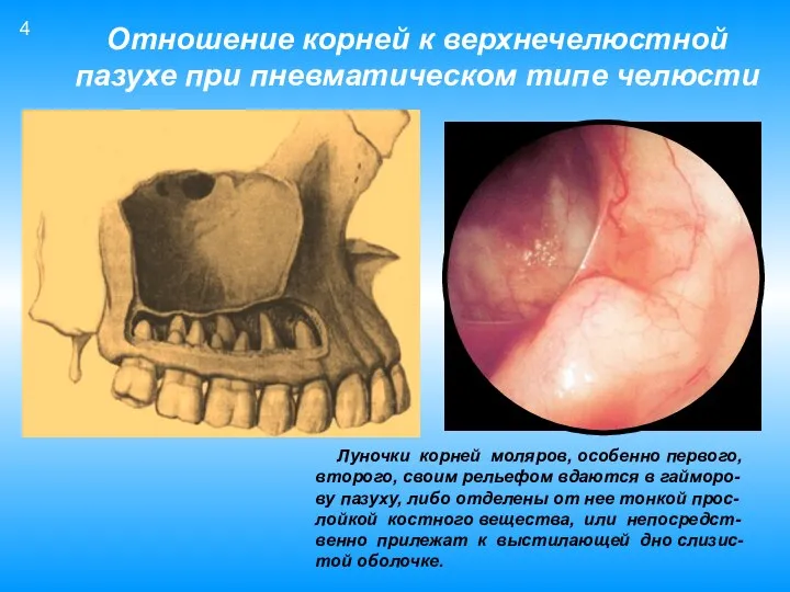 Отношение корней к верхнечелюстной пазухе при пневматическом типе челюсти Луночки корней