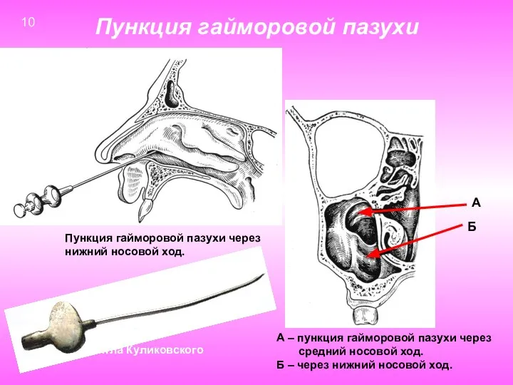 Пункция гайморовой пазухи А Б А – пункция гайморовой пазухи через