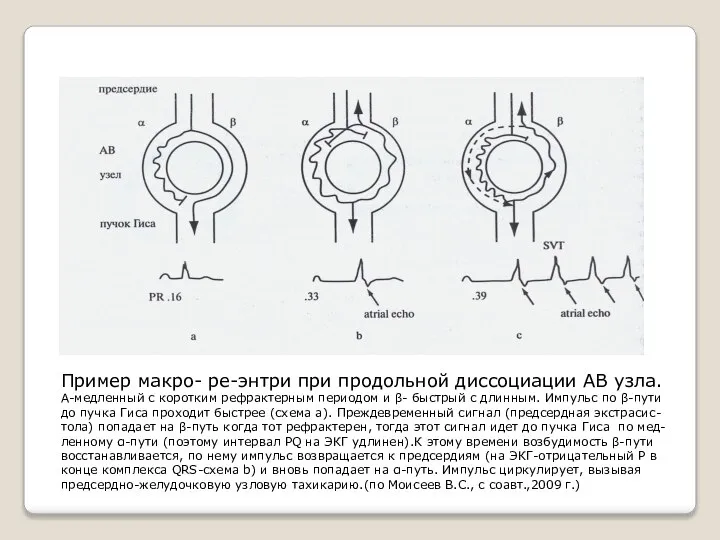 Пример макро- ре-энтри при продольной диссоциации АВ узла. Α-медленный с коротким