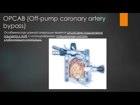 OPCAB (Off-pump coronary artery bypass) Особенностью данной операции является отсутствие подключения