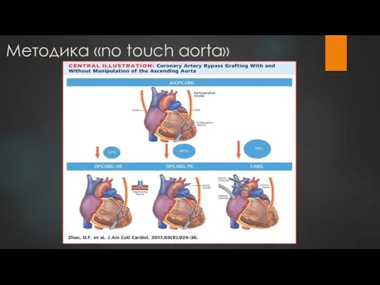 Методика «no touch aorta»