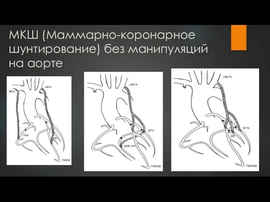 МКШ (Маммарно-коронарное шунтирование) без манипуляций на аорте