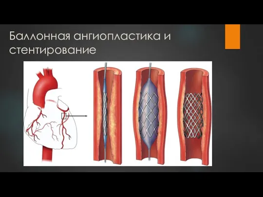 Баллонная ангиопластика и стентирование